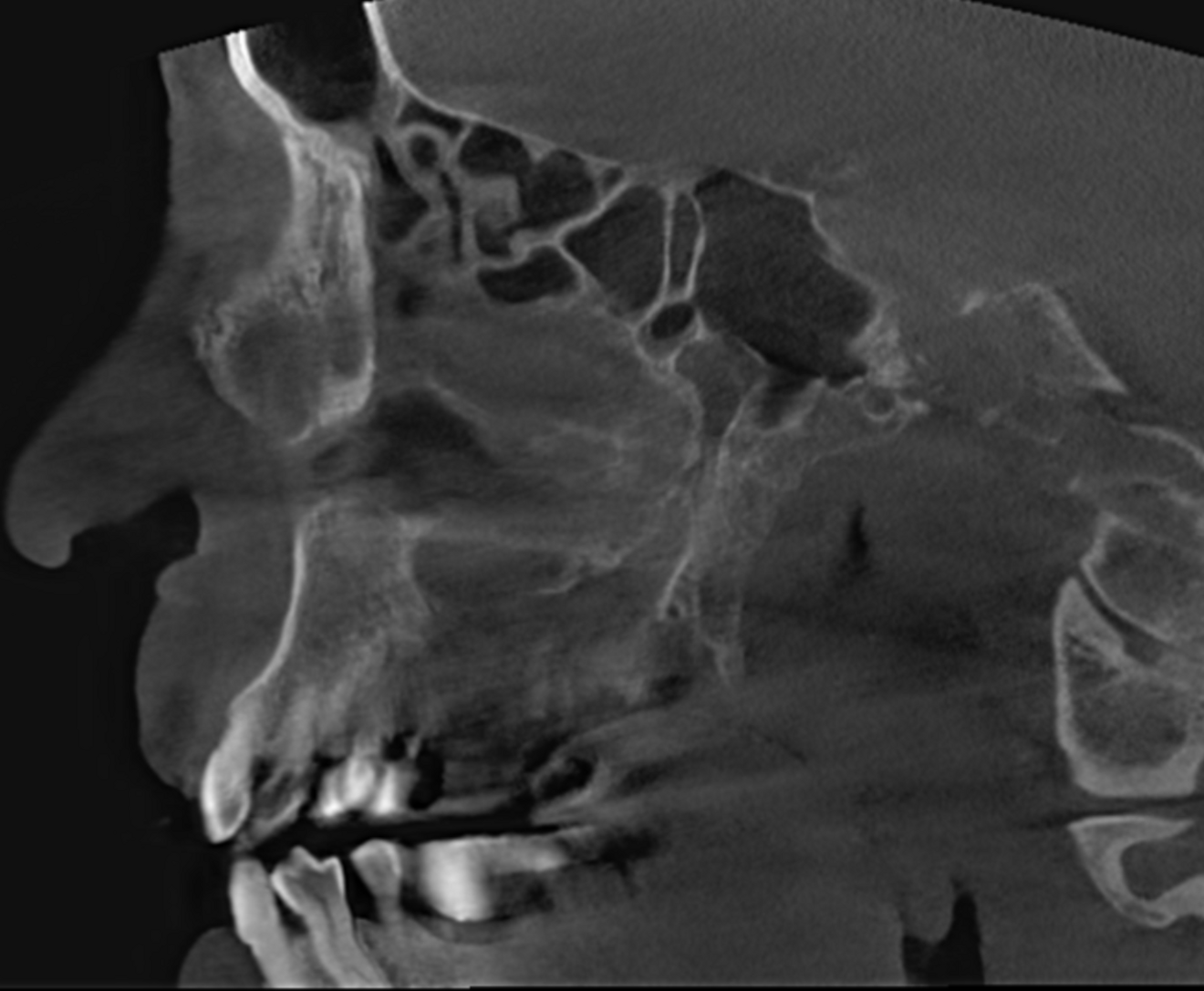 Fig. 4: Large-volume CBCT scan, sagittal cross-section of the right paranasal sinuses showing involvement of even the lower part of the cavernous sinus.