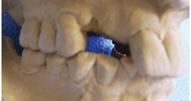 Lom implantata: Osvrt na fizičke mehanizme kliničkog neuspjeha