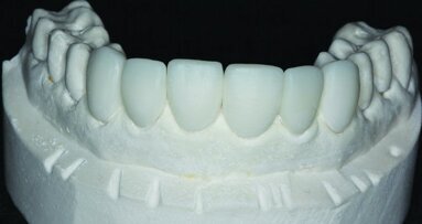 Sans stress (vraiment !)Facettes en résine nanocéramique