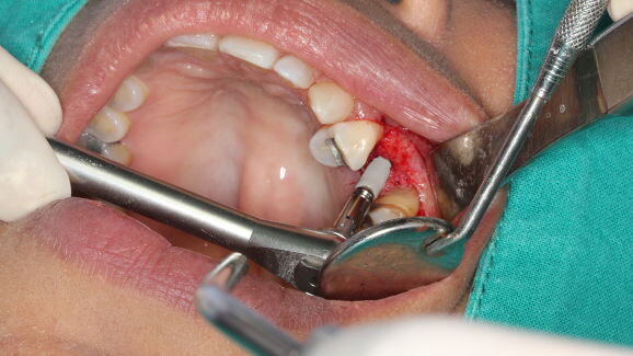 Many Saudi dentists not qualified to perform implant procedures