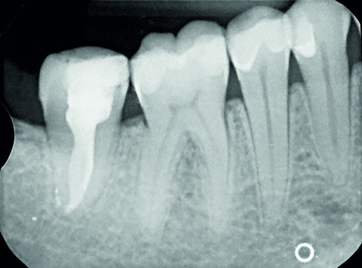 Fig. 18d: Radiographs: Eight-year recall.