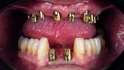 Impact of China’s volume-based procurement on the Asia Pacific dental implant market