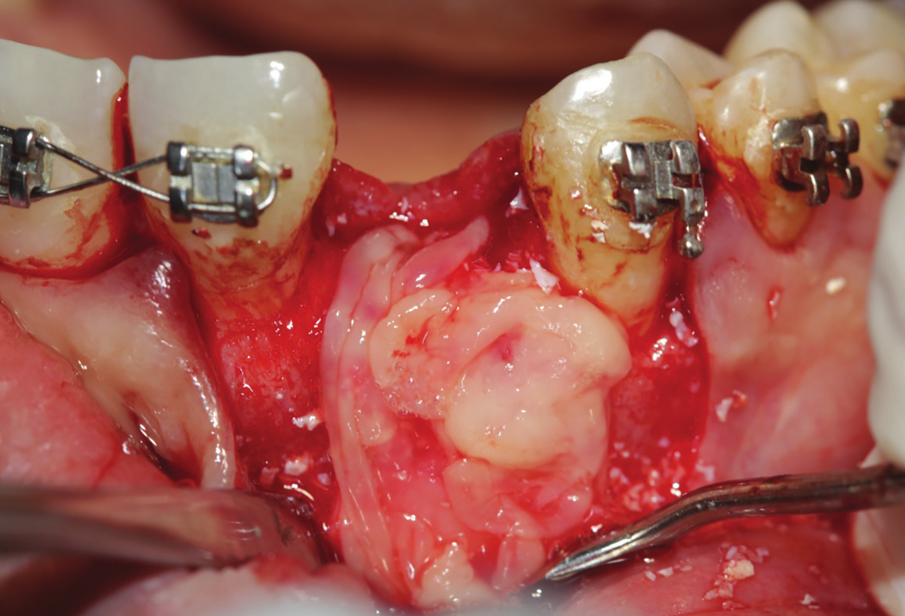 Figure 28: Second layer of L-PRFcovering the cross-linked collagen membrane covering the first complex.