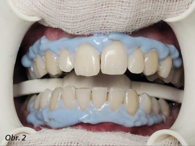 Obr. 2: Ochrana měkkých tkání při proceduře ordinačního bělení.