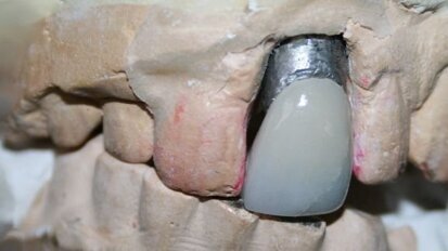 La dent d’Elvis exposée au Royaume-Uni, pour promouvoir la sensibilisation au cancer de la bouche