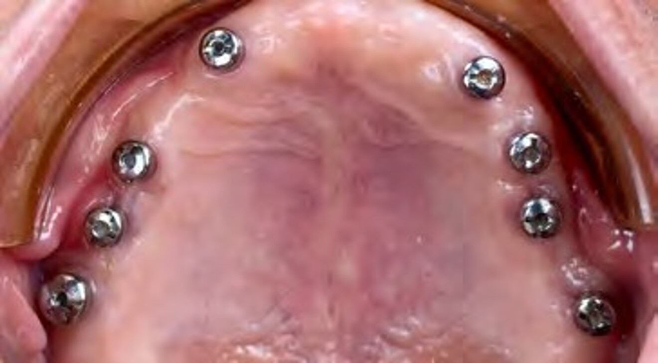 Fig. 2f: Occlusal view of the maxillary arch following healing abutment placement, showing healthy peri-implant soft tissue contours.