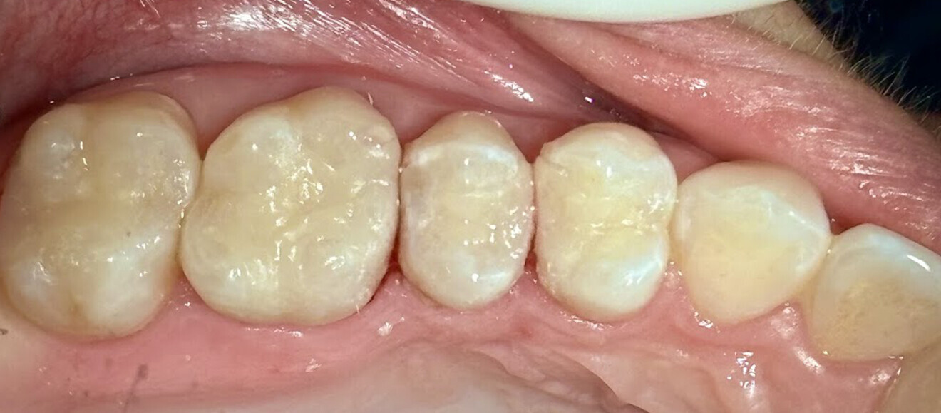 Fig. 26: Restorations luted to the prepared teeth after finishing and polishing.