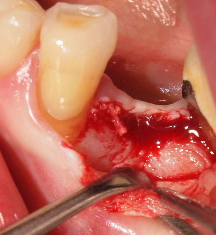 Fig. 6 - Caso clinico 1. Sollevamento di un lembo mucoperiosteo ed esposizione della corticale ossea. Si apprezza macroscopicamente l’assenza di fenomeni di carbonizzazione e danni termici dei tessuti molli e del tessuto osseo che mantiene un’adeguata vascolarizzazione.