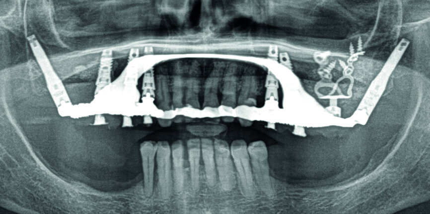 Figs. 8a et b : Contrôles radiologiques du bon ajustement des armatures après vissage. 