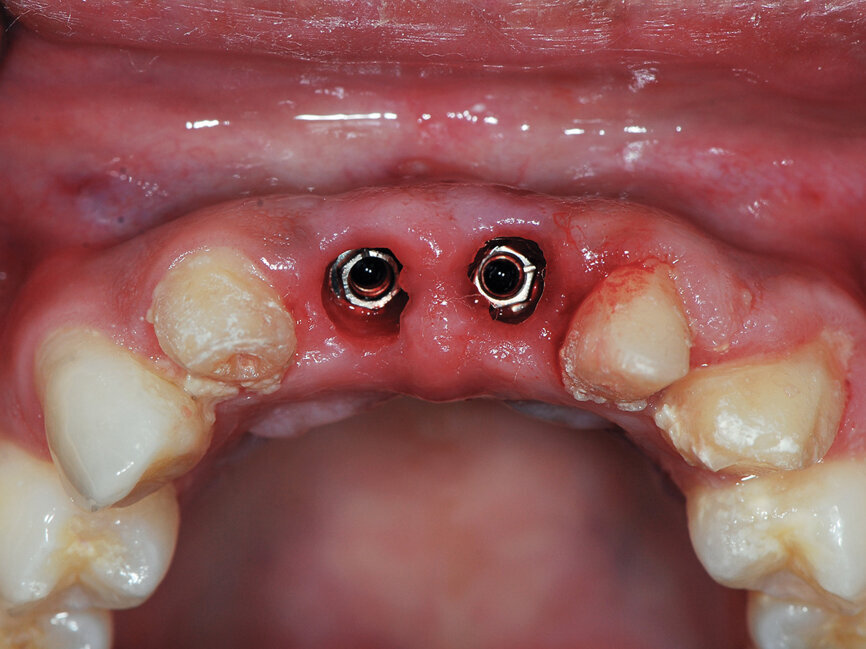 Fig. 11: Removal of the healing abutments at two weeks post-uncovery demonstrates a lack of inflammation of the modified soft tissue. (Photo provided by Dr. Gregori M. Kurtzman)