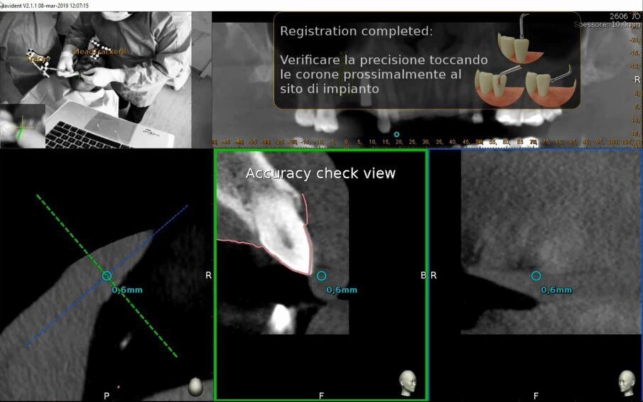 Figg. 13a-13c - Verifica di accuratezza. a) Verifica di accuratezza del Tracer dopo tastatura; b, c) Verifica di accuratezza della fresa prima della fresatura.