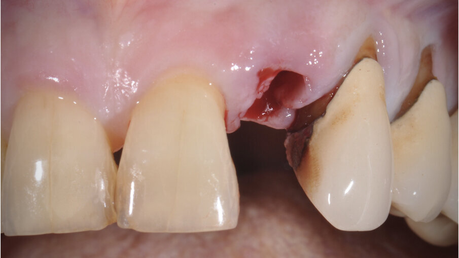 Fig. 3_Alveolo post-estrattivo.