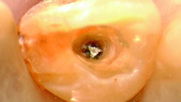 Le retraitement des infections périapicales: chirurgie ou pas ?