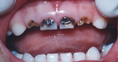 Coronas de resina vs. coronas de circonio en Odontopediatría