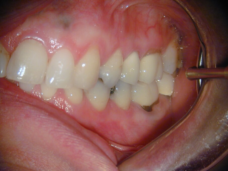 Afb. 9-11: Klinische foto’s van de 37-jarige follow-up