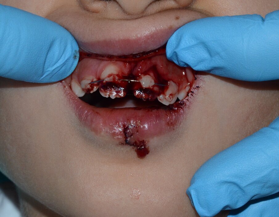 Figure 10b: The clinical appearance following a second trauma incident that happened within two hours of  fitting the dental splint.