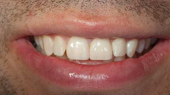 A BruxZir solid zirconia veneer case