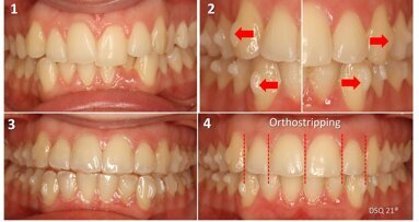 Alineadores: Biomecánica básica de los Ataches (1ª Parte)