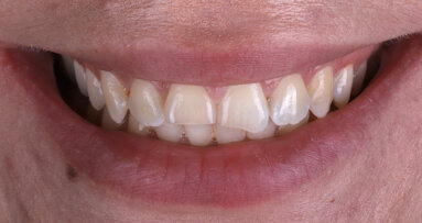 From trauma to harmony: A minimally invasive approach to anterior aesthetics