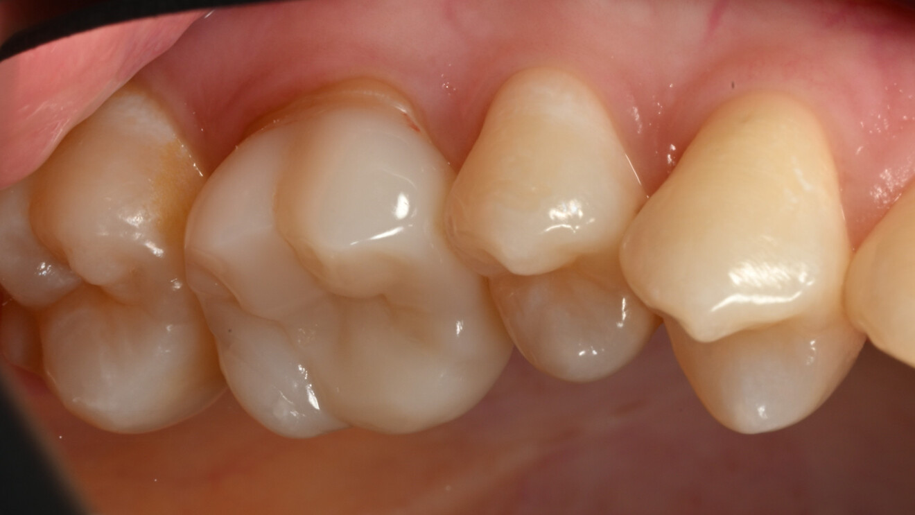 Fig. 33c: Oblique occlusal view.