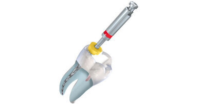 Webinar: Herausforderungen der Aufbereitung gekrümmter Wurzelkanäle