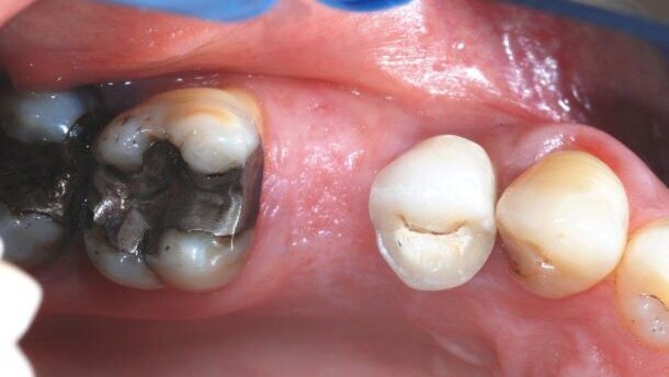 Alveolaire Ridge Preservation