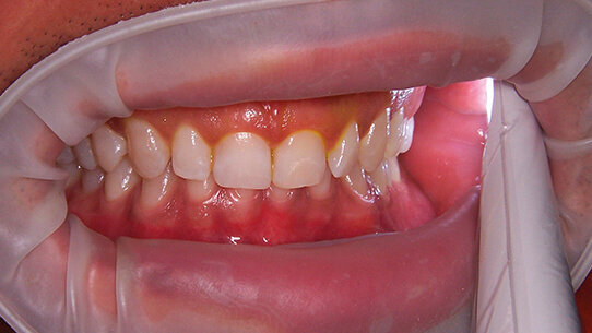 Ipersensibilità dentinale