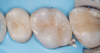 Direct cuspal coverage with resin composite