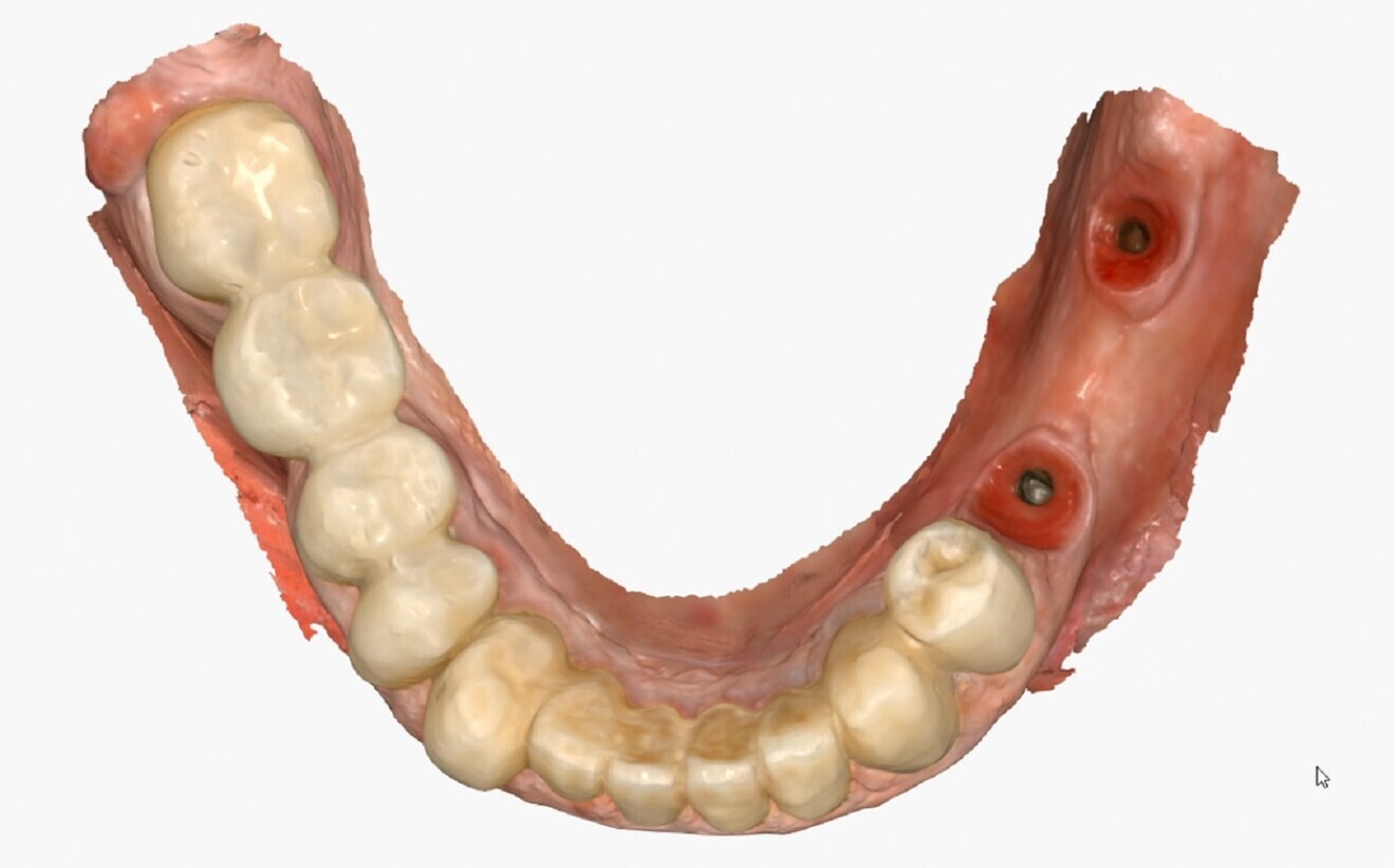 Fig. 3: Extreme fidelity of capture of the implant position and surrounding tissue profile using the ProCam scan bodies.