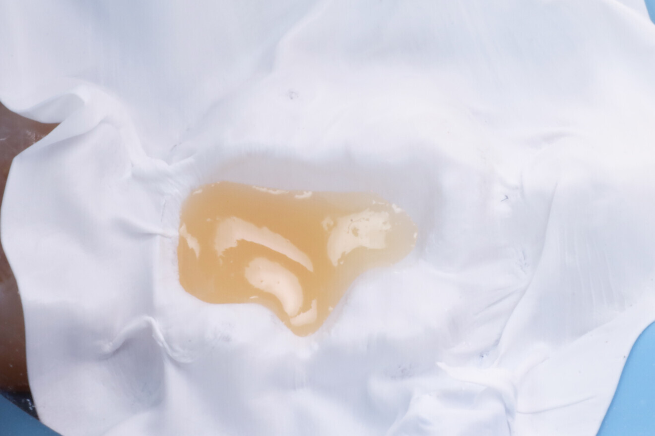 Fig. 15: Short-fibre-reinforced composite placed in the dentine region.