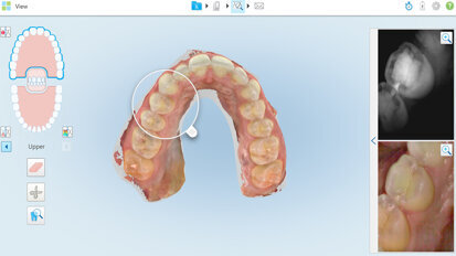 Novo kliničko ispitivanje potvrdilo novi način otkrivanja i praćenja interproksimalnog karijesa