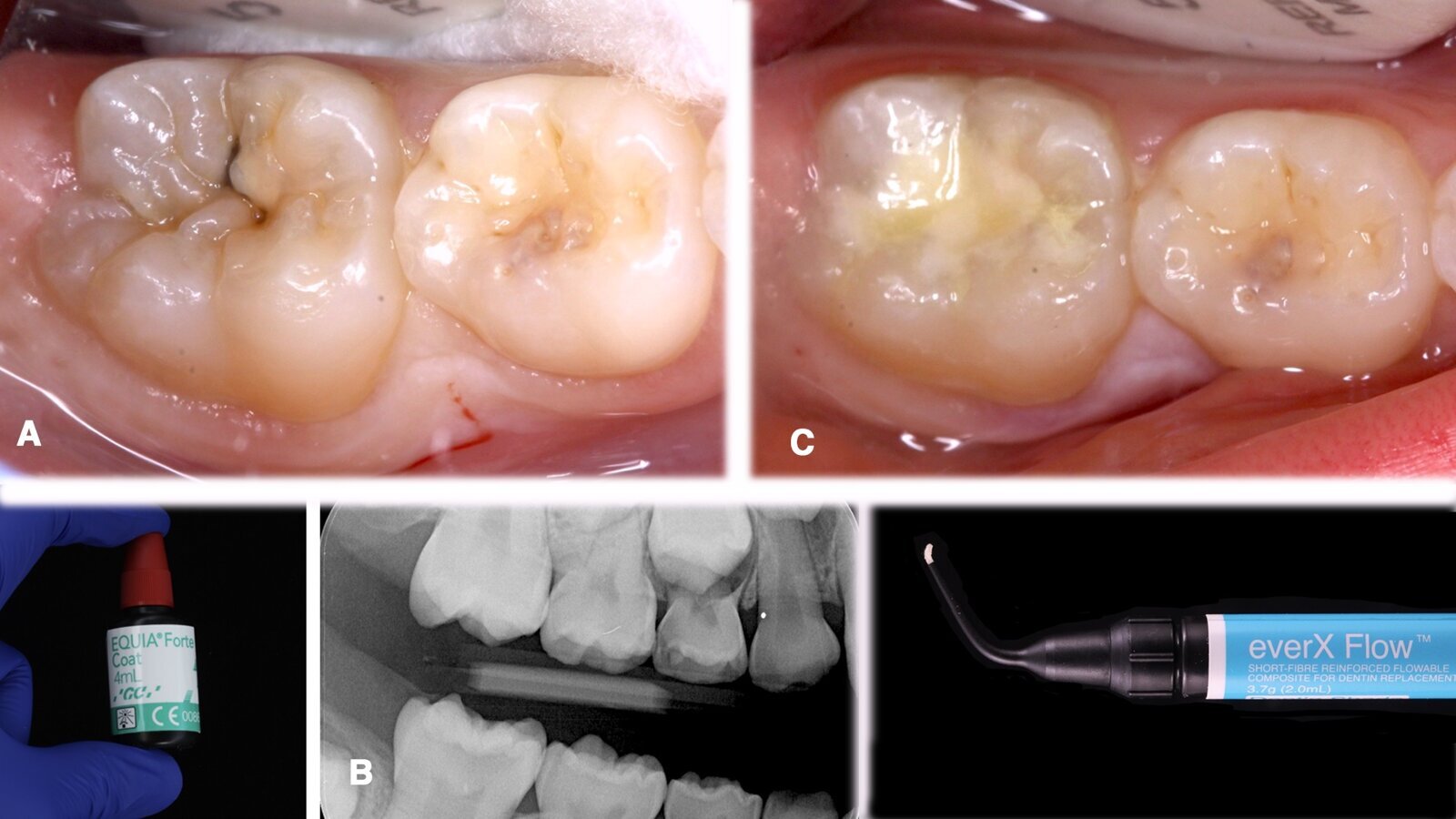 Decisiones clínicas en restauraciones directas