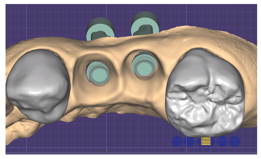Fig. 10_File CAD di lavoro che replica il condizionamento tissutale creato dai provvisori.