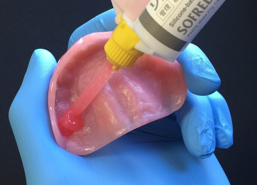 Fig. 10: Dispensing SOFRELINER TOUGH into immediate denture.