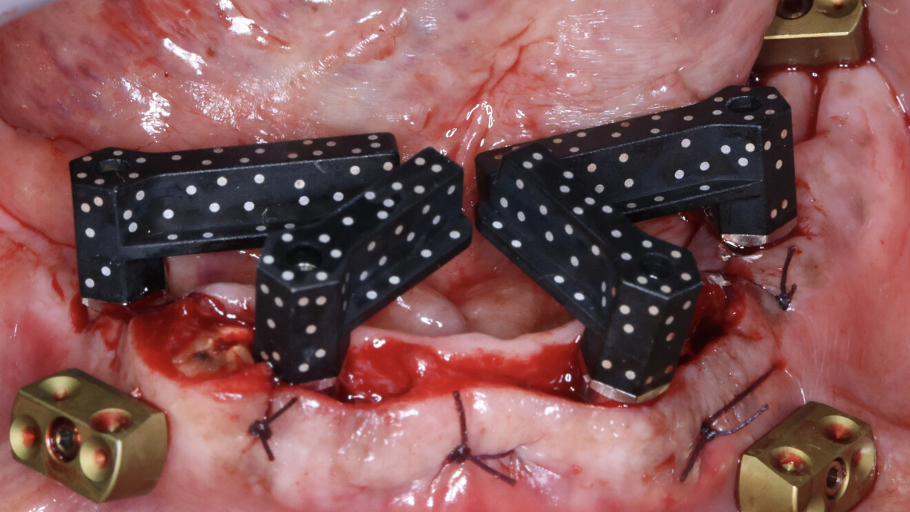 Fig. 13: Photogrammetric scan bodies connected to the mandibular implants immediately after surgery.