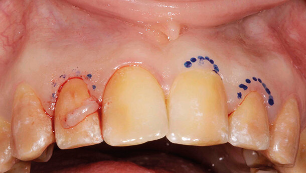 Trattamento estetico-funzionale in un caso di amelogenesi imperfetta generalizzata