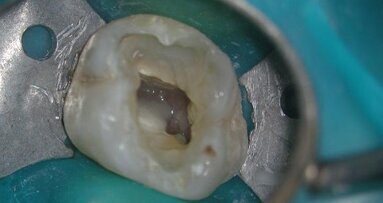 Twisted Files changed the world of endodontics - case report