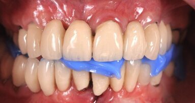 Restaurations définitives pour un nouveau sourire