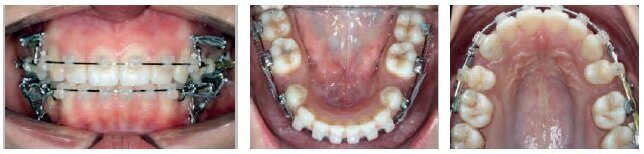 At 11 months of treatment, when the patient moved to Montreal