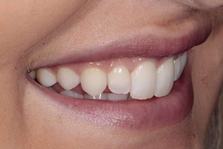14. Na behandeling met aligner en bleken, rechter vooraanzicht