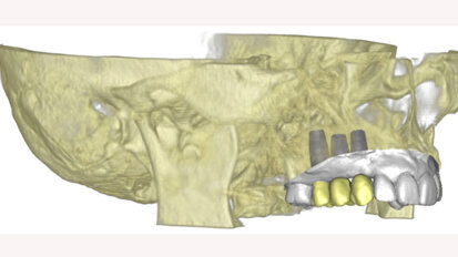 Materialise Dental is celebrating 20 years of 3-D Digital Dentistry Materialise Dental is celebrating 20 years of 3-D Digital Dentistry