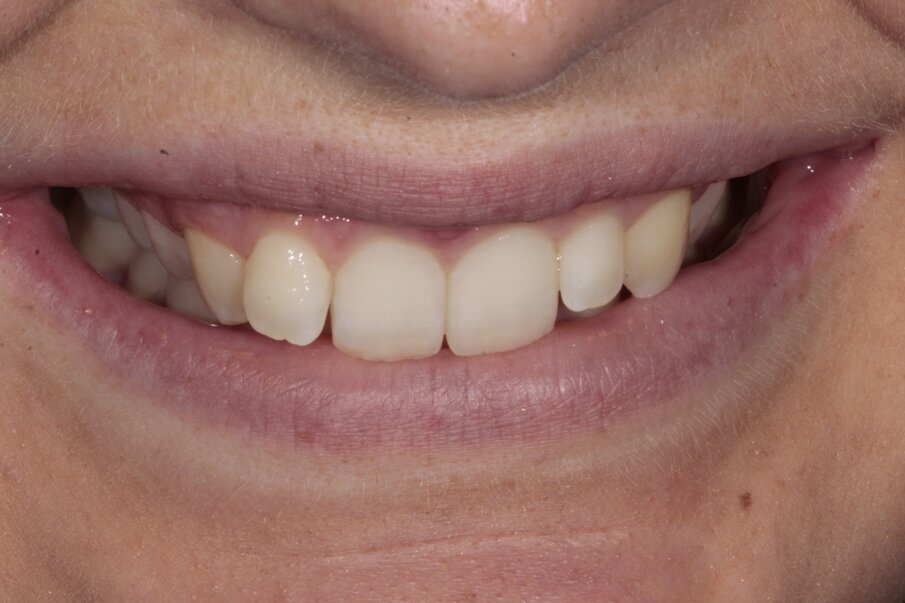 4. Initiële situatie, vooraanzicht