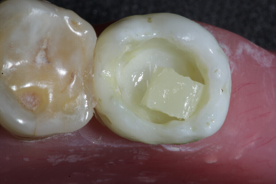 Fig. 26a: The first dose of fibre-reinforced membrane cube is applied into the cavity to protect the walls of the large cavity.