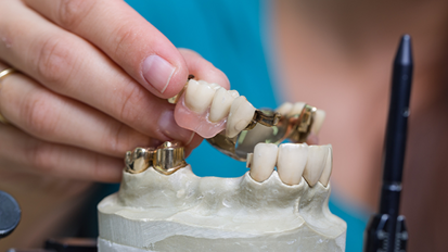 Adhäsivbrücken mit Metallgerüst jetzt GKV-Leistung Adhäsivbrücken mit Metallgerüst jetzt GKV-Leistung