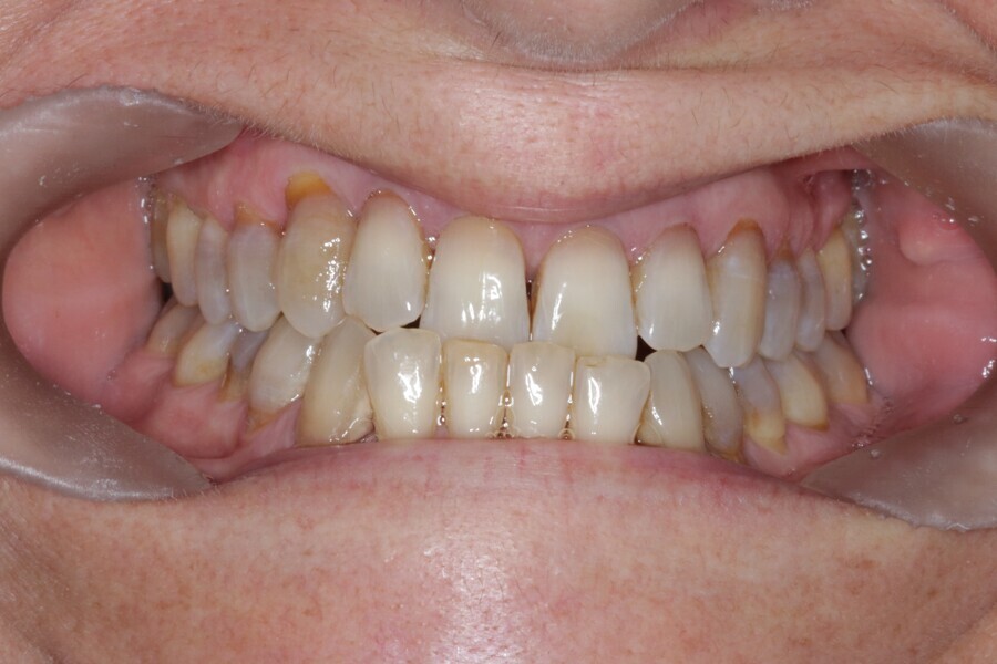 Fig. 27: Initial situation. Class III malocclusion patient.