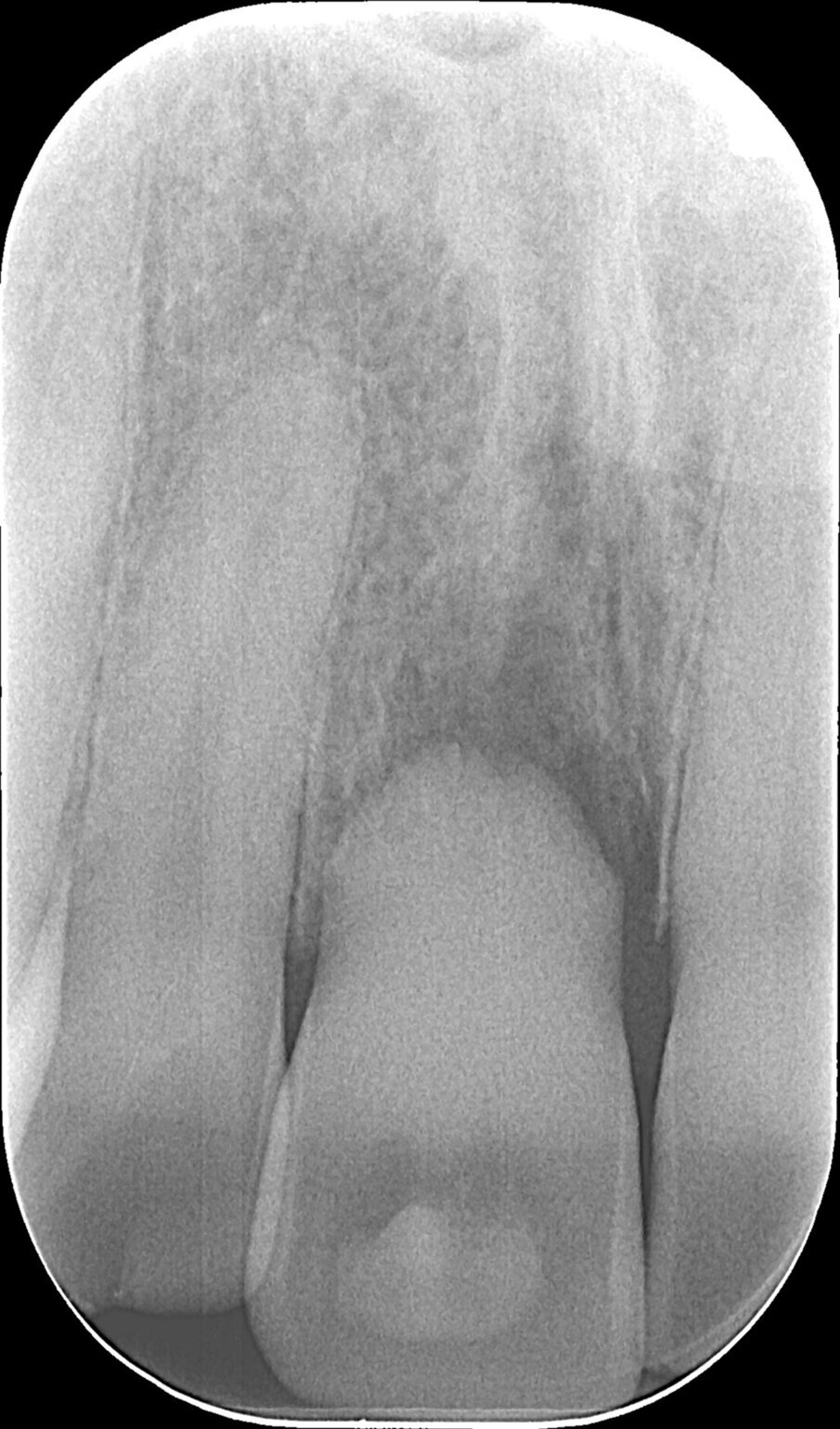 Fig. 2 - Alla rx si evidenzia un severo riassorbimento della sua radice