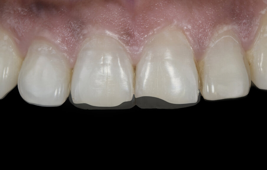 Fig. 15: Before and after image digitally overlapped to showcase extent of actual build-up of the composite restoration