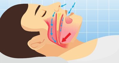 Rivisitazione delle linee guida mondiali per la diagnosi delle apnee notturne