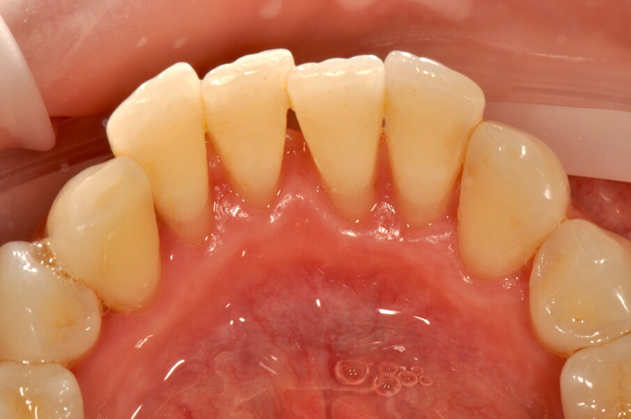 Figg. 5a-5c - Rivalutazione a 2 settimane si noti la completa risoluzione dell’infiammazione gengivale, nelle visioni vestibolare (5a), palatale (5b) e linguale (5c).