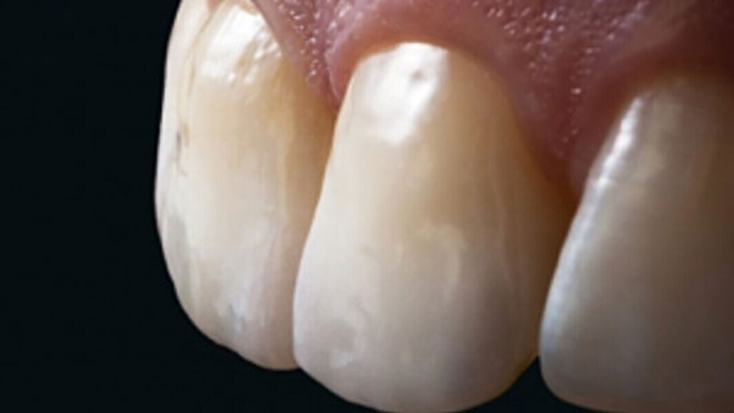 Fig. 13. La morfología y la textura superficial de ambas restauraciones de cerámica sin metal ya no se distinguían de los dientes adyacentes naturales.